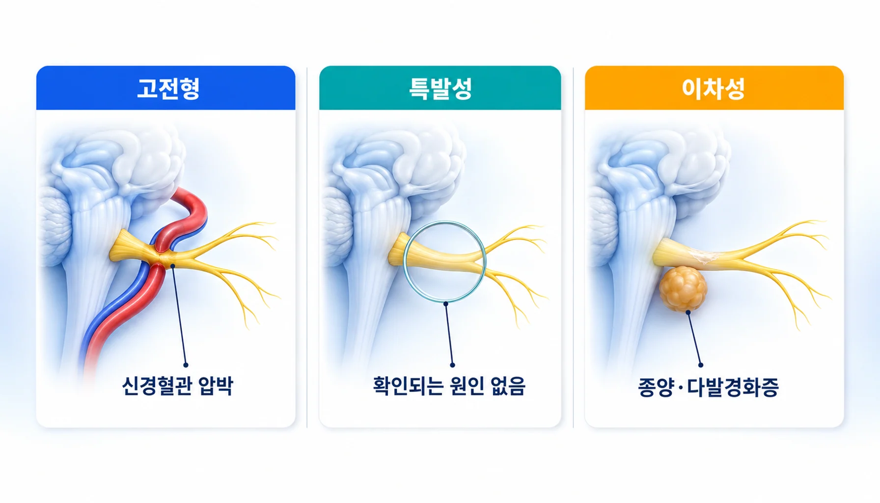 국제두통질환분류가 나누는 고전형·특발성·이차성 삼차신경통의 세 갈래 비교