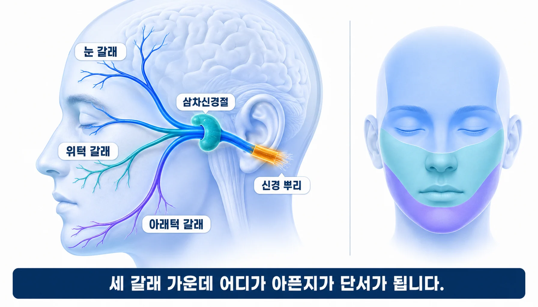 삼차신경의 세 갈래와 신경뿌리 부위를 보여주는 구조 그림