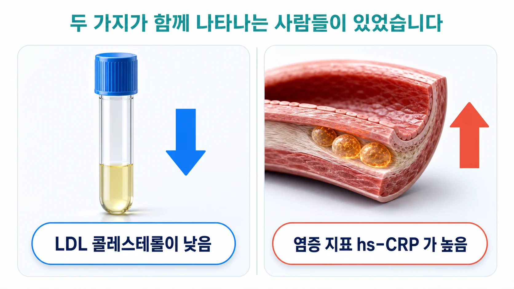 LDL이 낮은 사람에게서 염증 지표인 고감도 C반응단백이 오히려 높게 나타난 관계를 그린 그림
