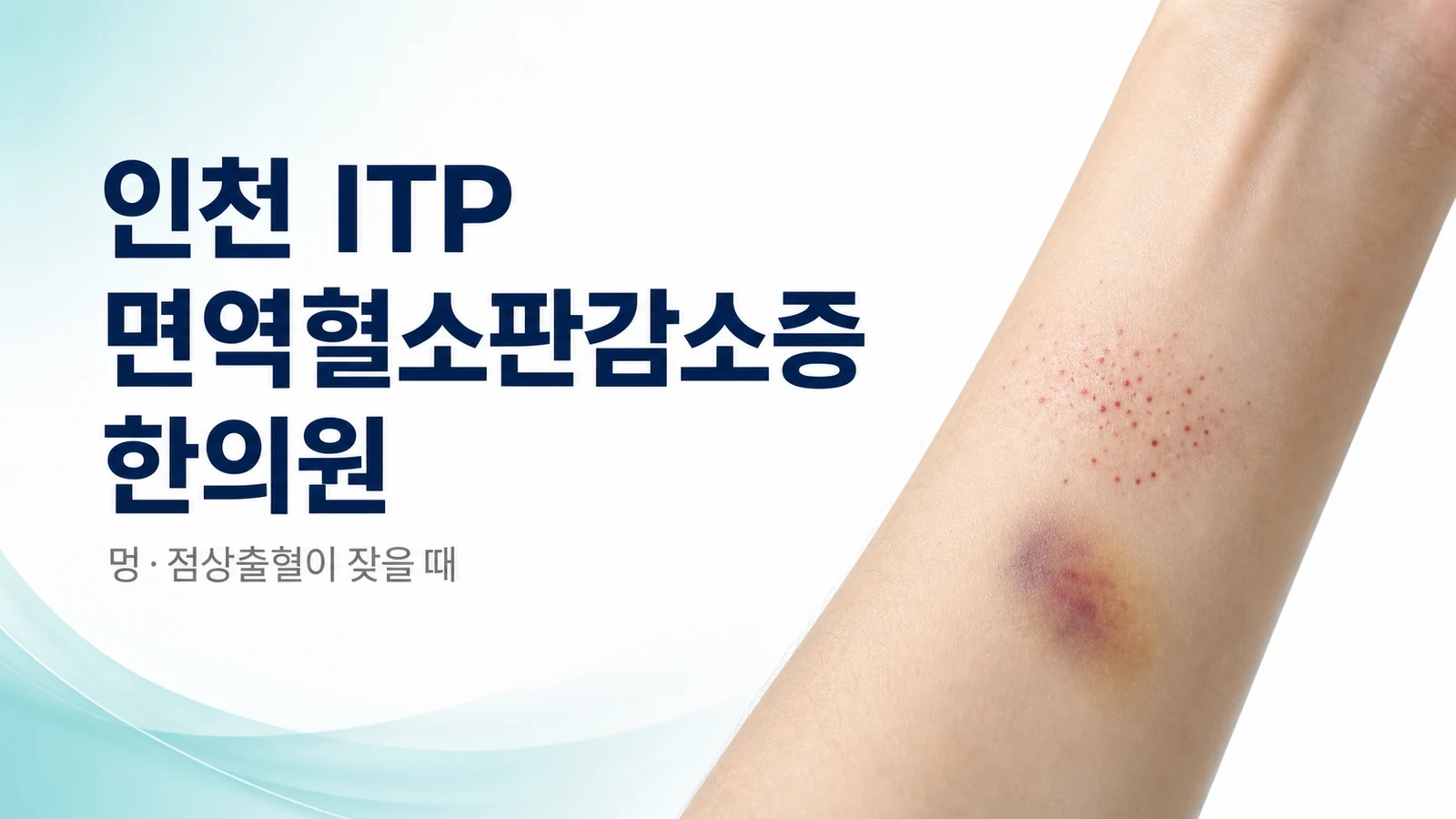 ITP 면역혈소판감소증 — 멍·점상출혈이 잦을 때