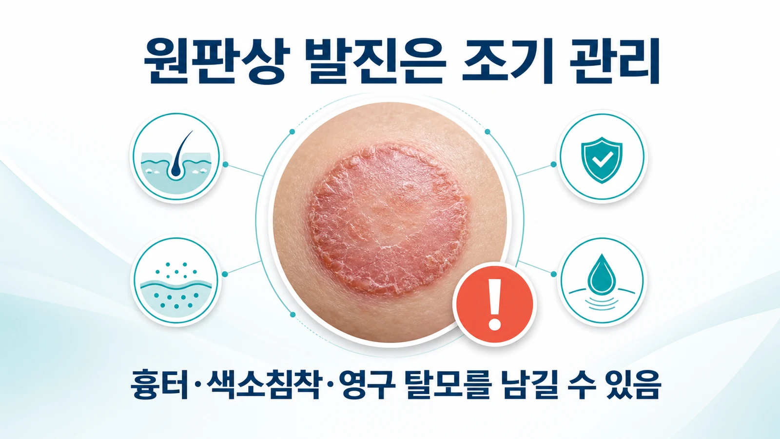 광과민·원판상 발진 관리
