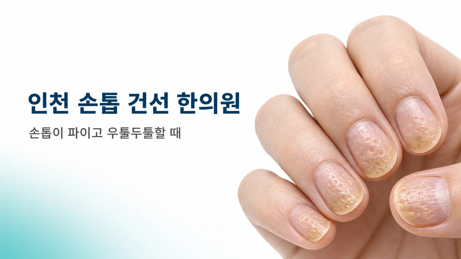 손톱 건선 — 손톱이 파이고 우툴두툴할 때
