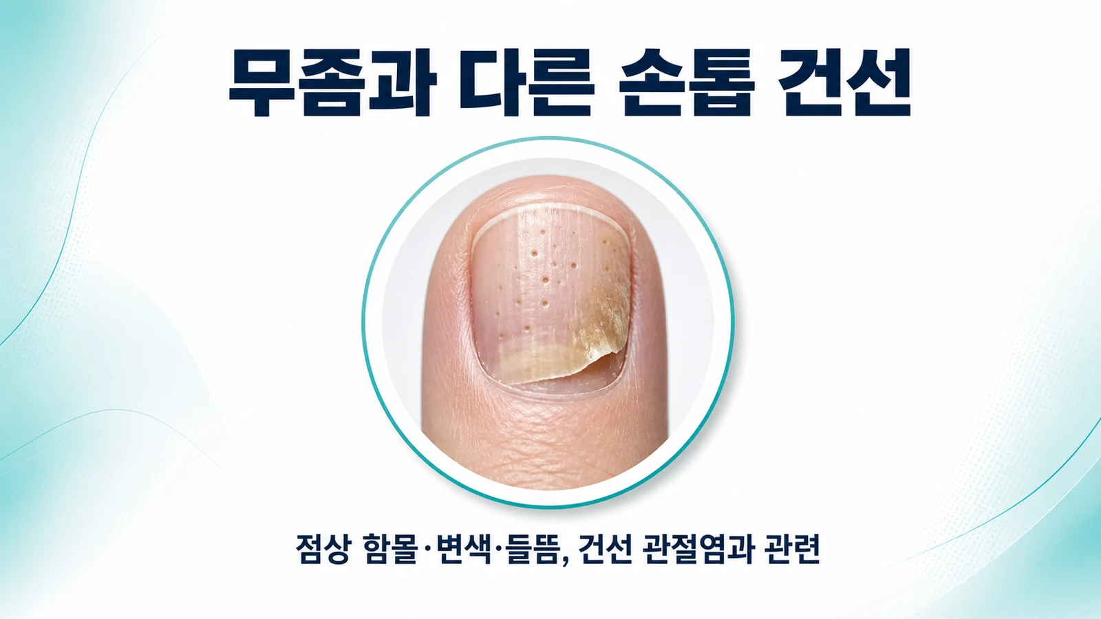 손톱이 파이고 우툴두툴할 때