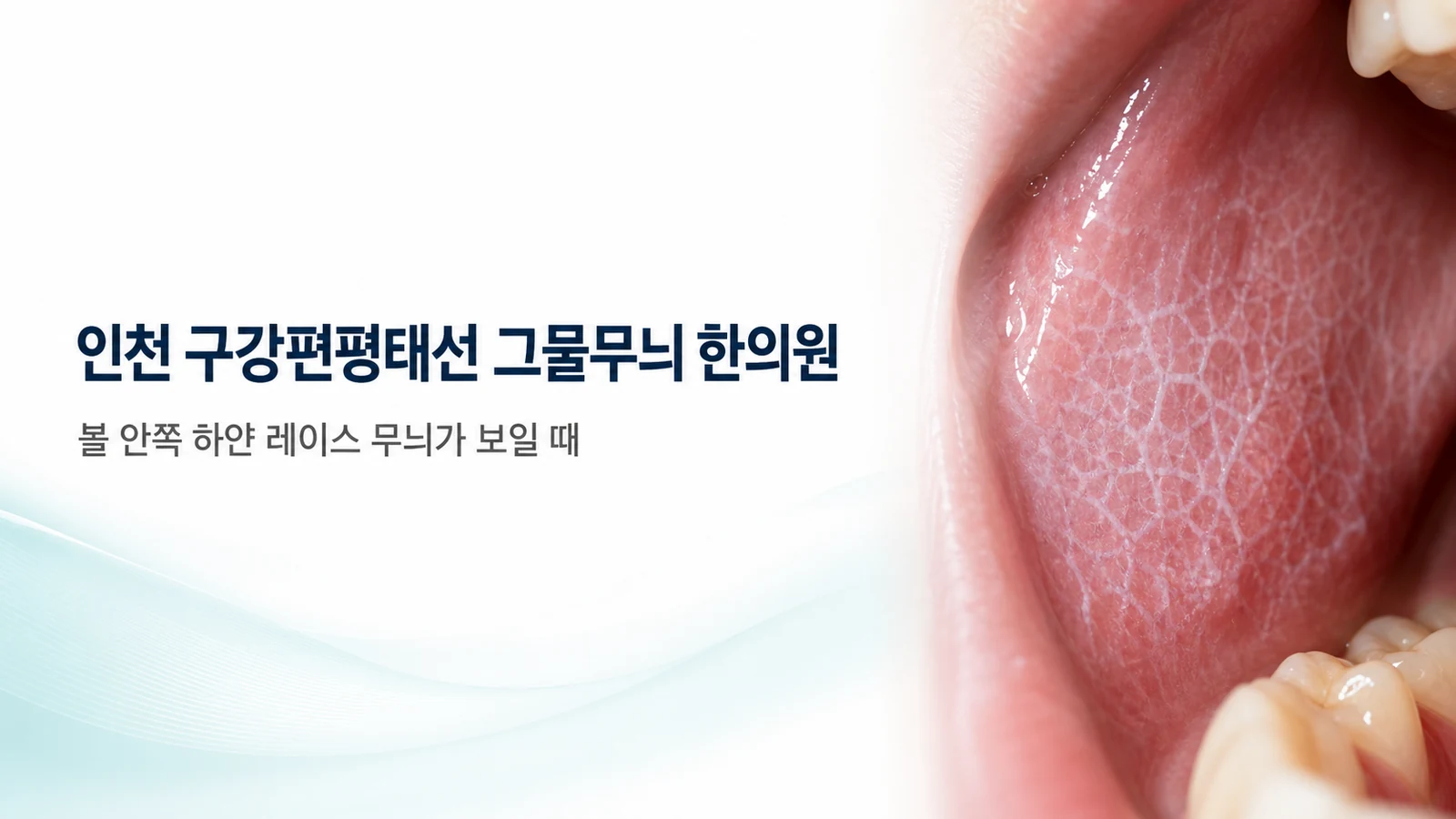 구강편평태선 그물무늬 — 볼 안쪽 하얀 레이스 무늬가 보일 때