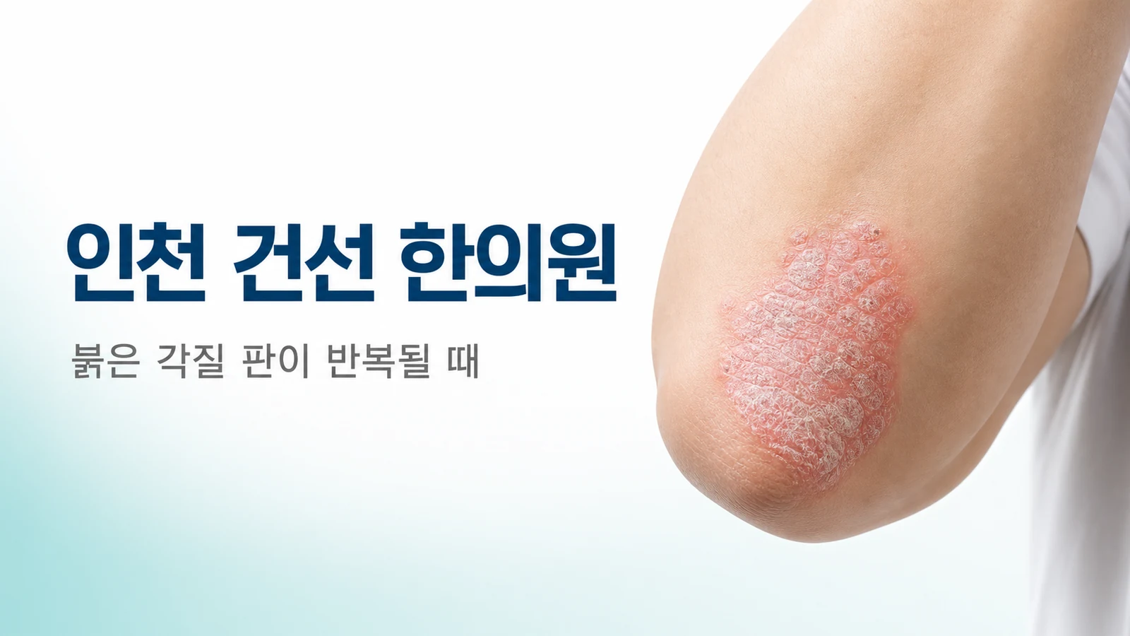 건선 — 붉은 각질 판이 반복될 때 한방 치료