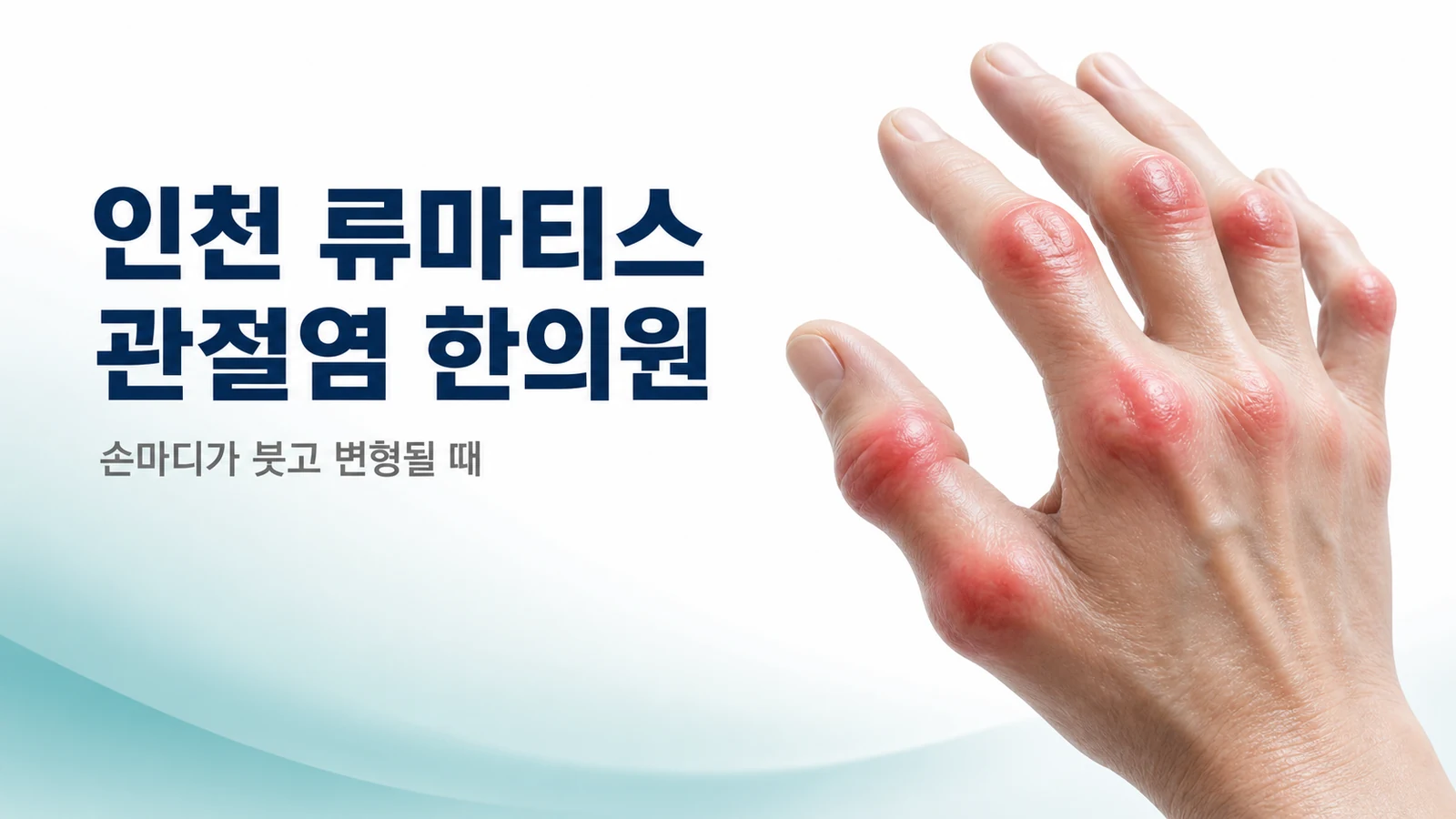 류마티스 관절염 — 손마디가 붓고 변형될 때 한방 관리