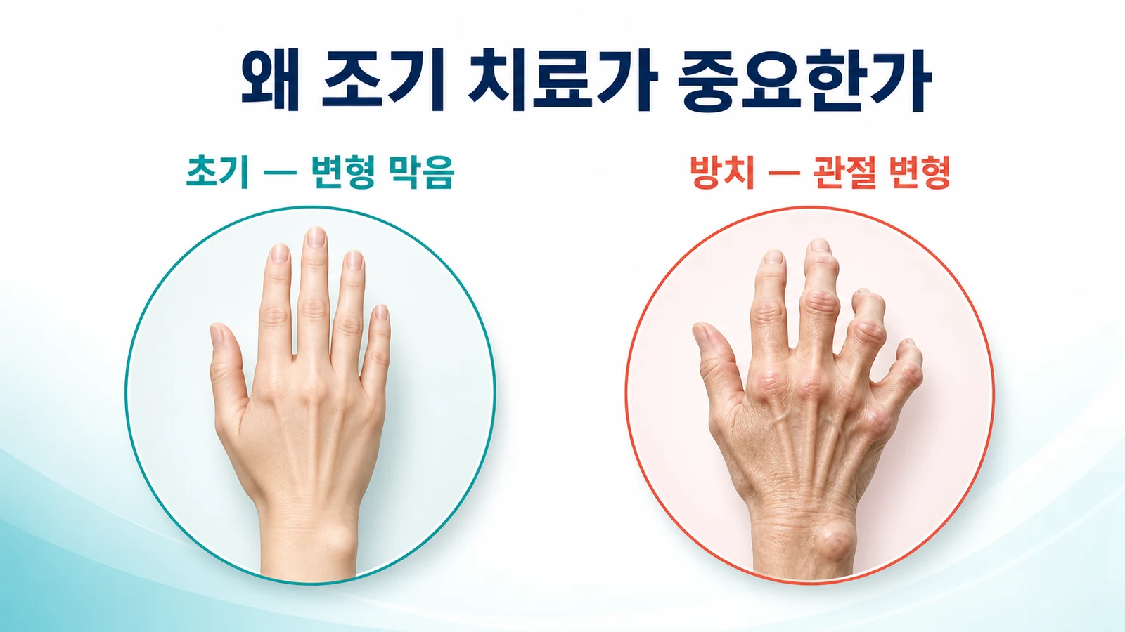 손마디가 붓고 변형될 때