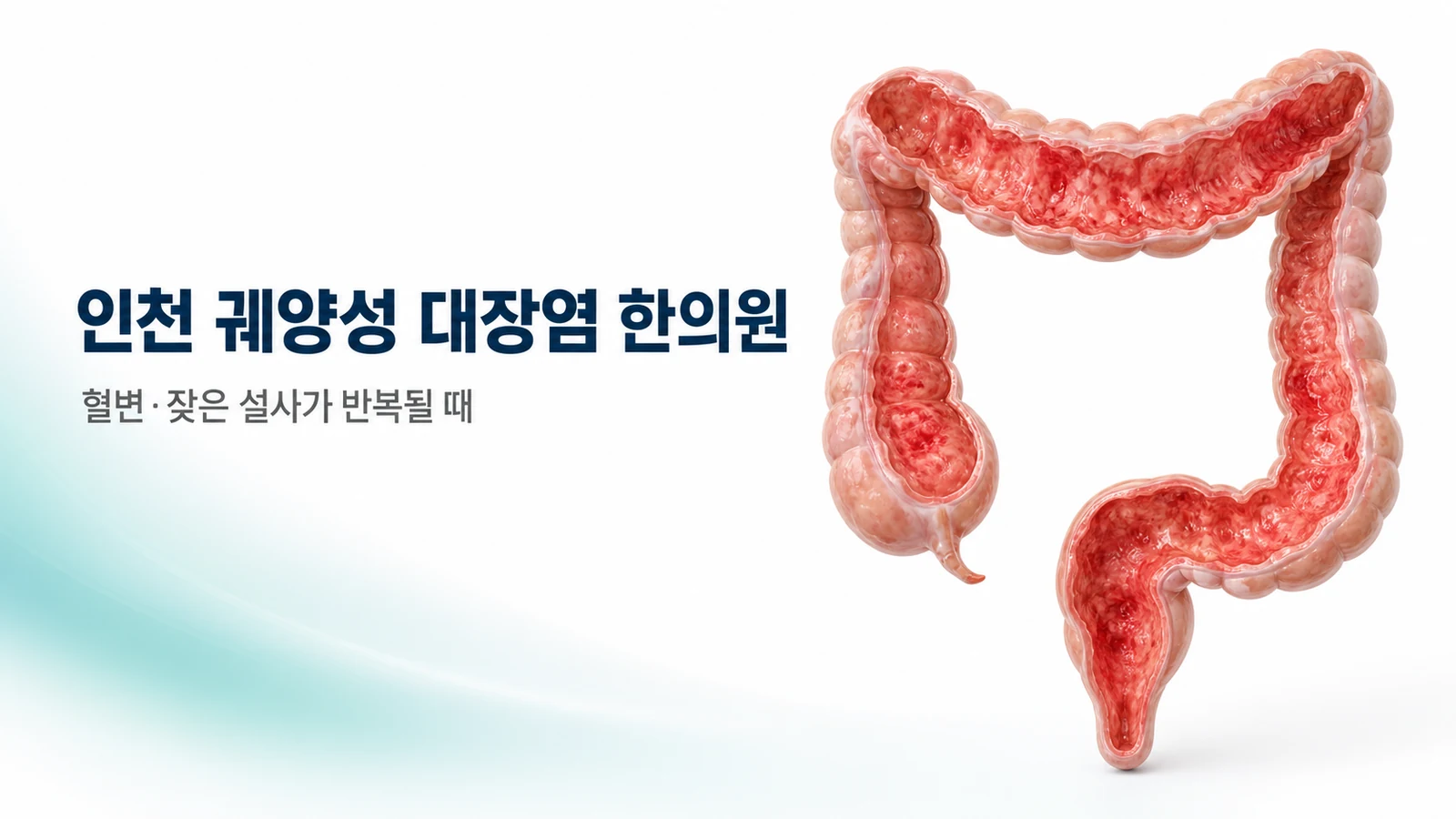 궤양성 대장염 — 혈변·잦은 설사가 반복될 때 한방 관리