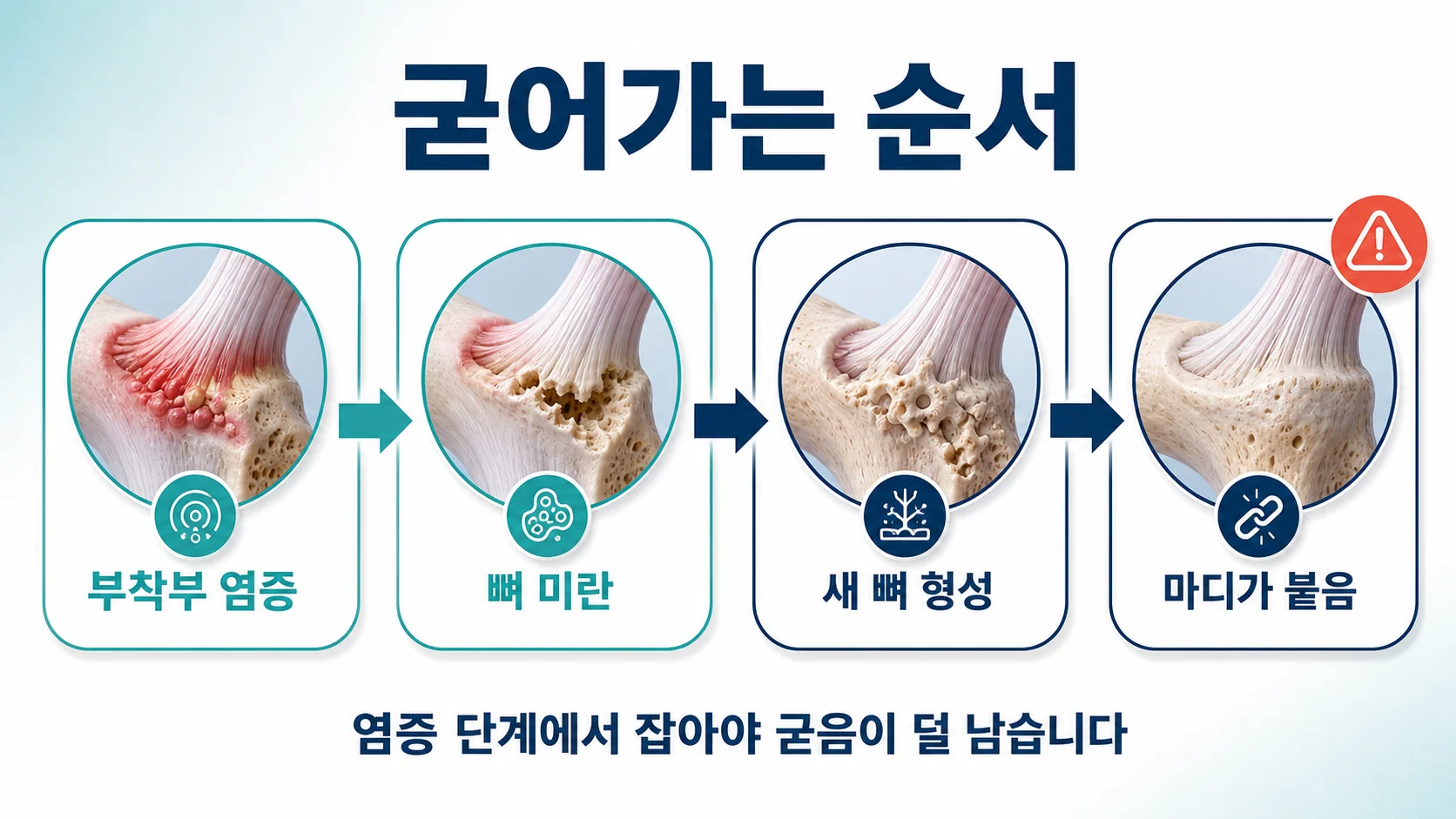 부착부 염증에서 마디가 붙기까지의 진행 순서를 정리한 도식