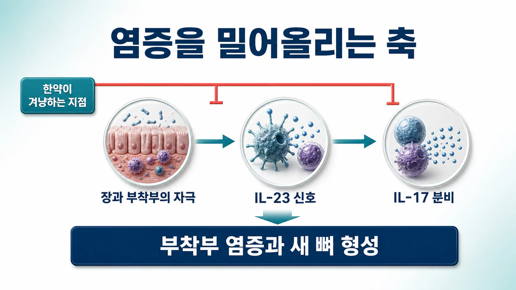 IL-23과 IL-17 축이 부착부 염증을 밀어올리는 경로를 정리한 도식