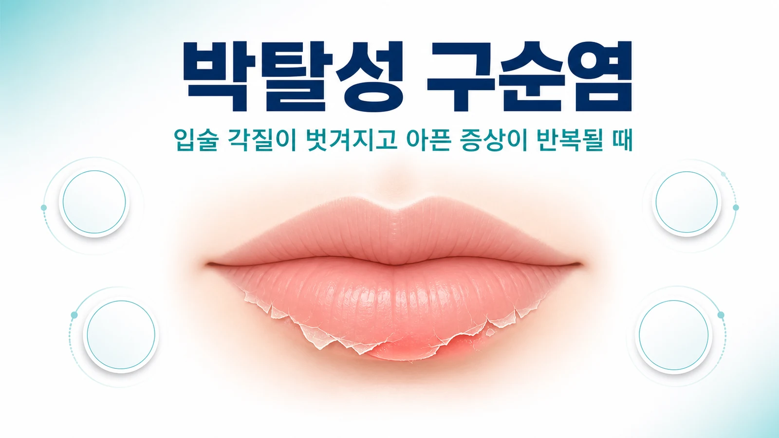 입술 각질이 벗겨지고 아픈 박탈성 구순염을 나타낸 대표 그림