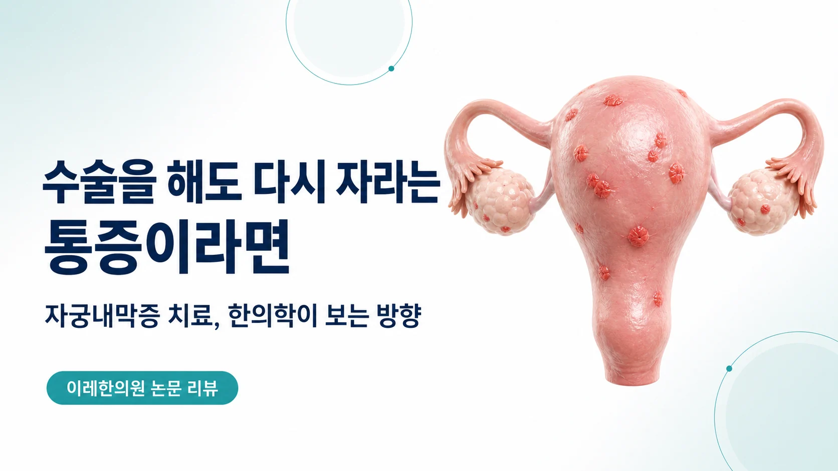 수술을 해도 다시 자라는 통증을 다루는 자궁내막증 글의 표지 이미지