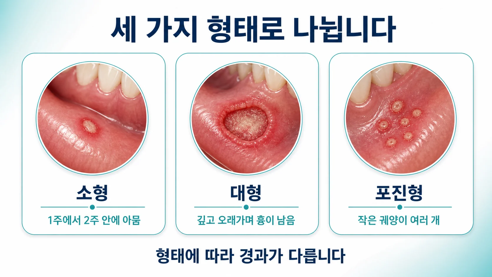 구내염의 세 가지 형태를 정리한 도식