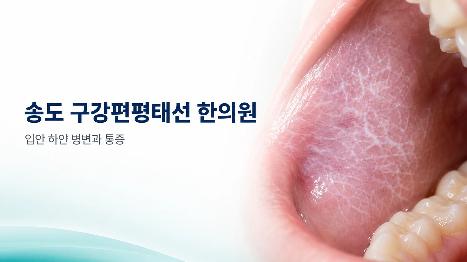 구강편평태선 — 입안 하얀 줄무늬와 통증, 한방 치료