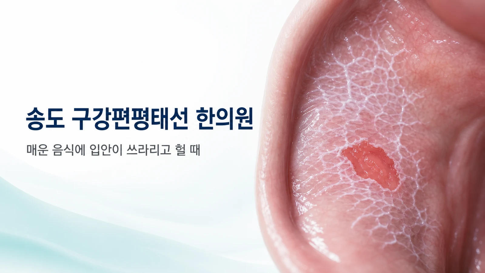 구강편평태선 — 매운 음식에 입안이 쓰라리고 헐 때