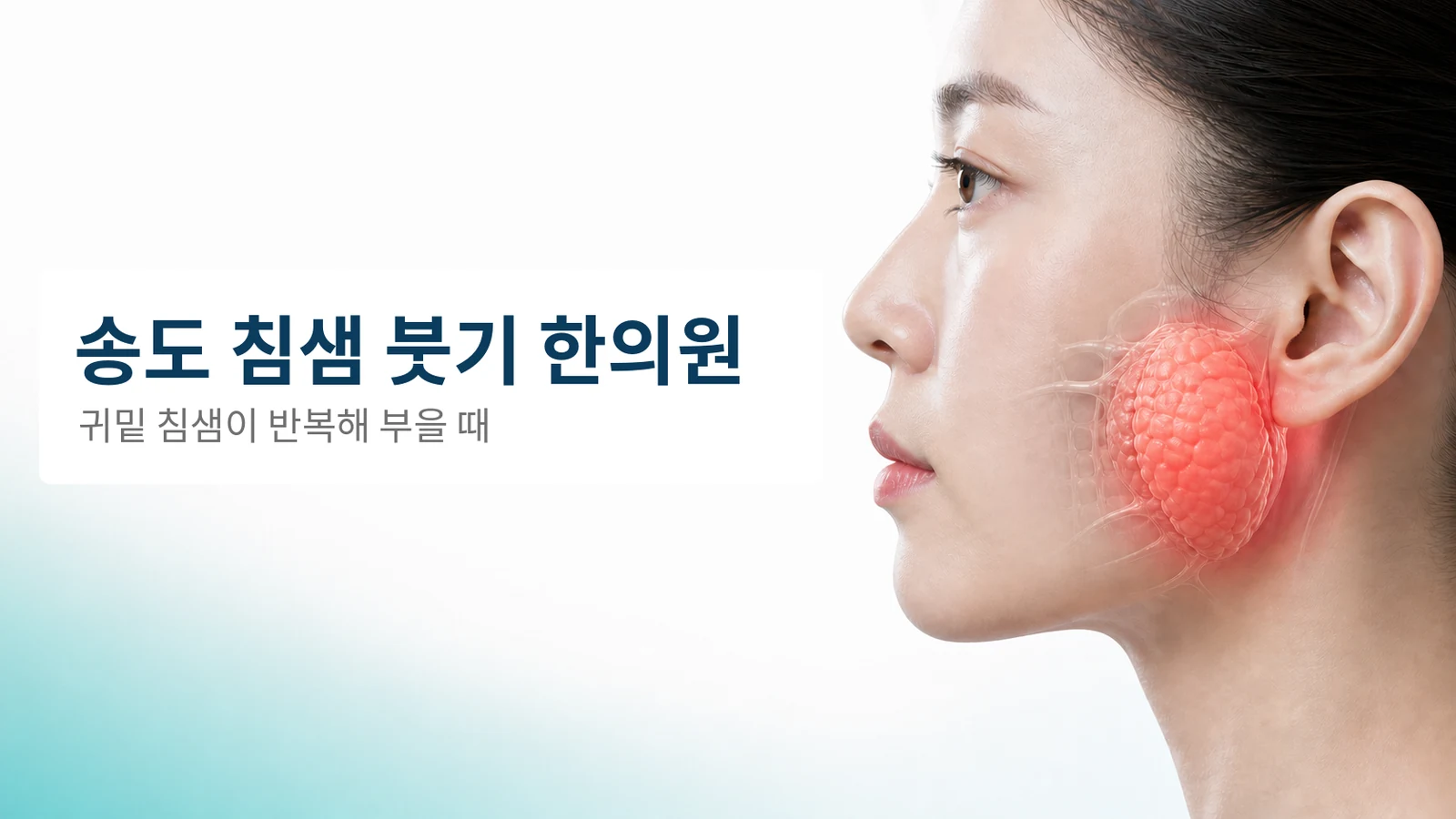 침샘 붓기 — 귀밑 침샘(이하선)이 반복해 부을 때 치료