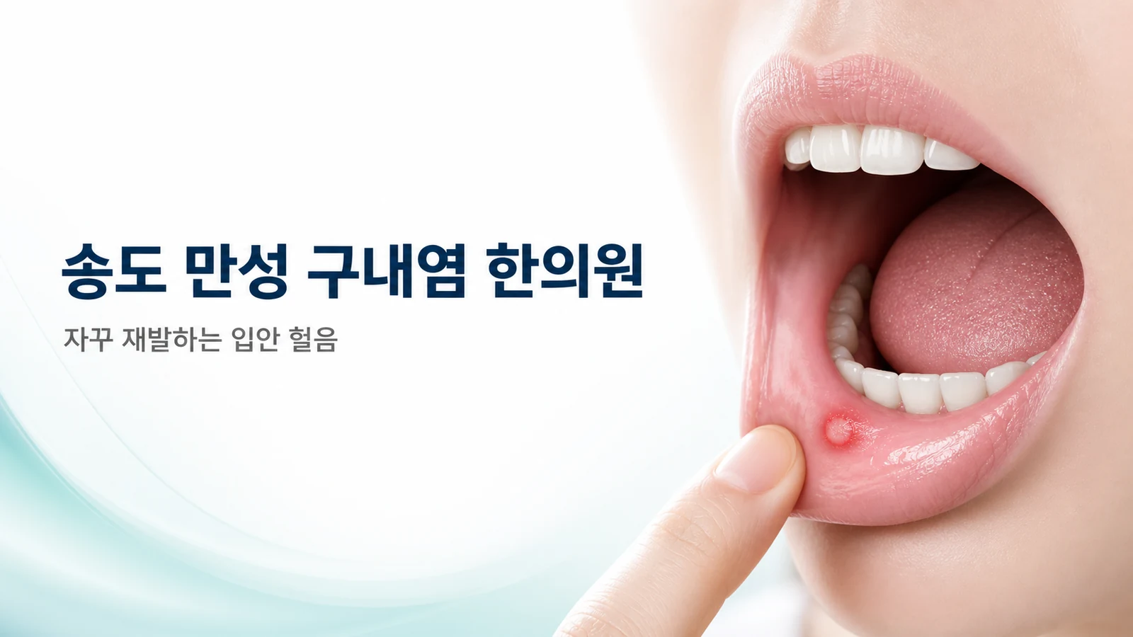 만성 구내염 — 자꾸 재발하는 입안 헐음, 한방 치료